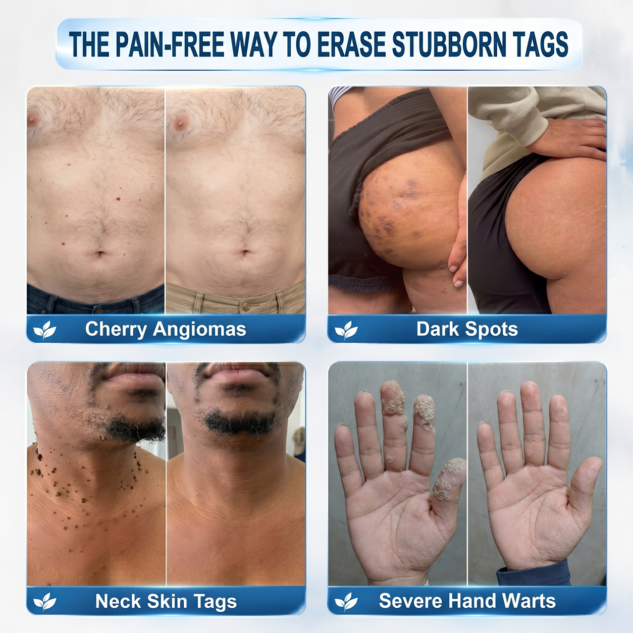 Dewvely® 7-𝐃𝐚𝐲 𝐒𝐤𝐢𝐧 𝐓𝐚𝐠 & 𝐒𝐩𝐨𝐭 𝐄𝐫𝐚𝐬𝐞𝐫 𝐂𝐫𝐞𝐚𝐦 (Pain-Free, Scar-Free Formula)
