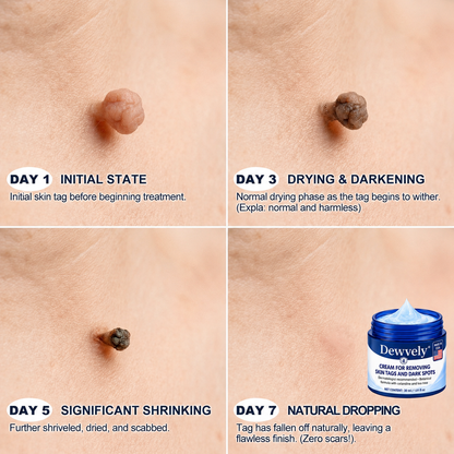 Dewvely® 7-𝐃𝐚𝐲 𝐒𝐤𝐢𝐧 𝐓𝐚𝐠 & 𝐒𝐩𝐨𝐭 𝐄𝐫𝐚𝐬𝐞𝐫 𝐂𝐫𝐞𝐚𝐦 (Pain-Free, Scar-Free Formula)